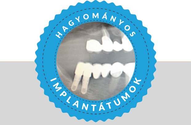Hagyományos implantáció