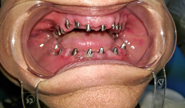 Azonnal terhelhető implantátum szájba helyezés közben